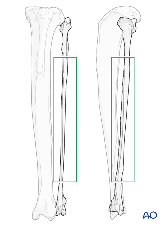 Incomplete tibial fracture or fracture with fibula intact