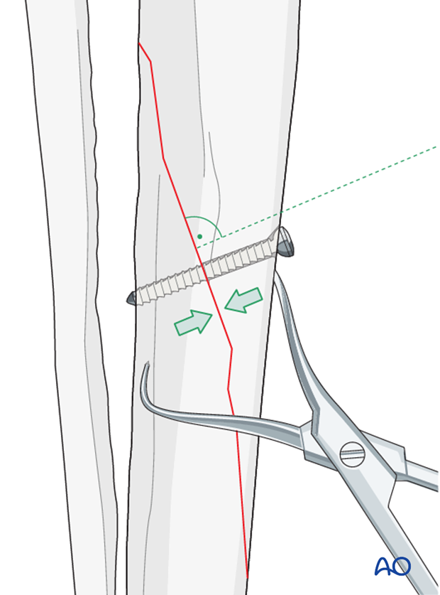 lag screw fixation