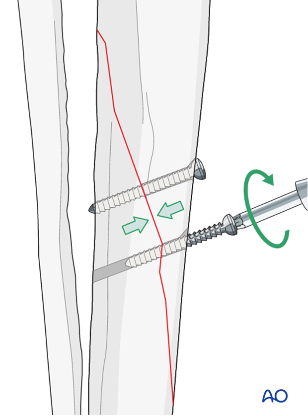 lag screw fixation