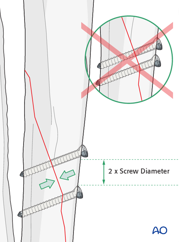 lag screw fixation