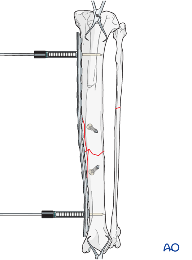 lag screw with neutralization plate