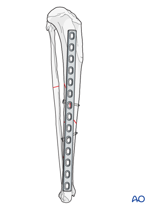 lag screw with neutralization plate