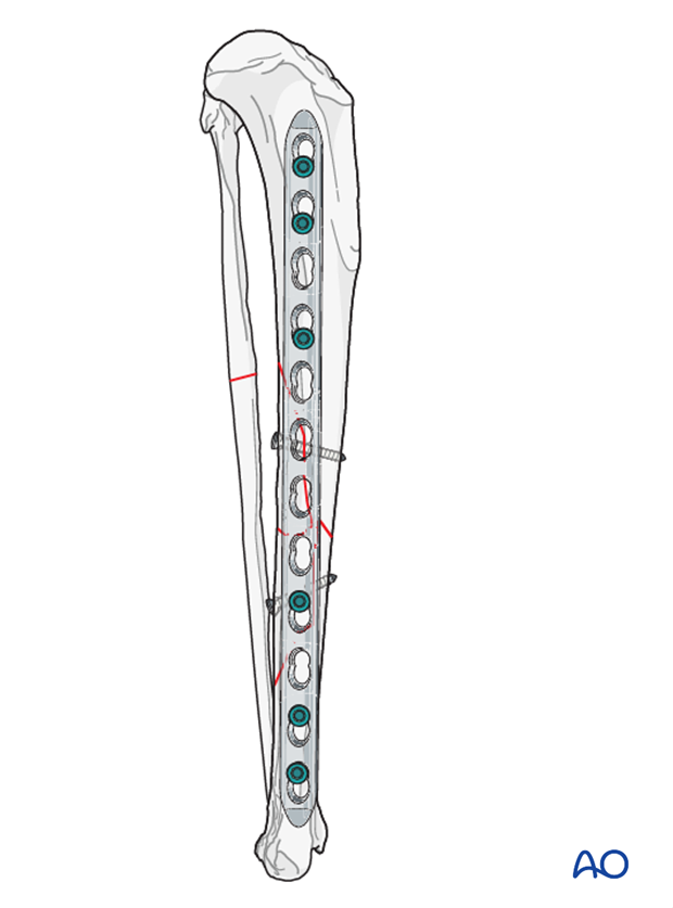 lag screw with neutralization plate