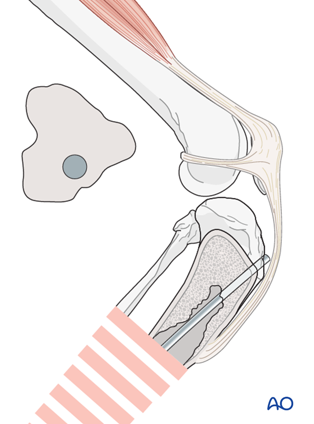 plate and rod