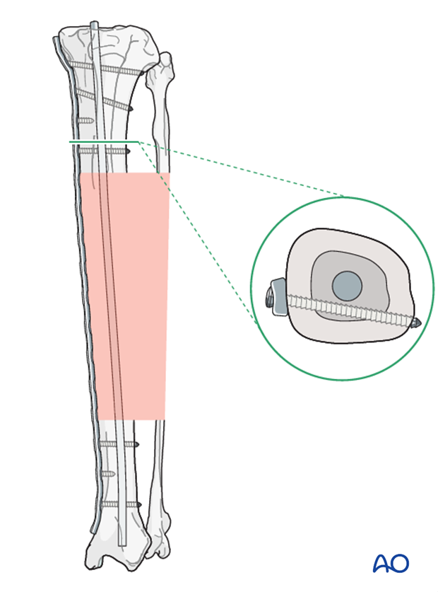 plate and rod