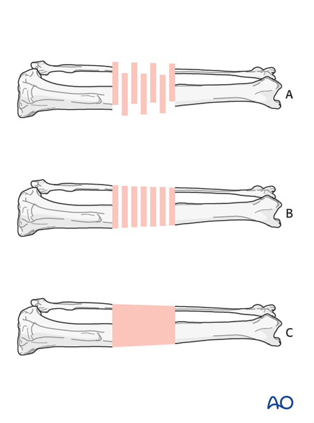 bridging plate