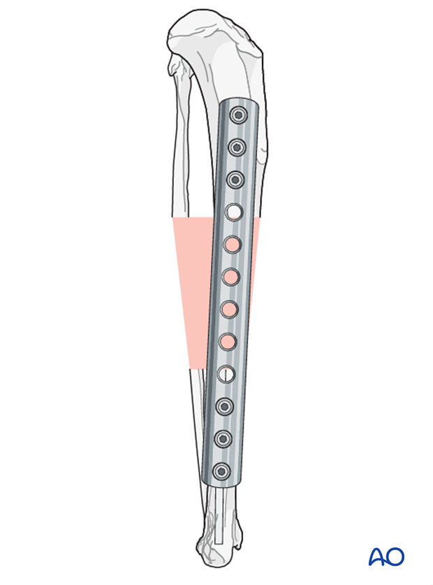 bridging plate