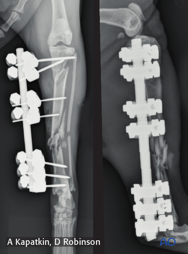 complications with tibial shaft fractures