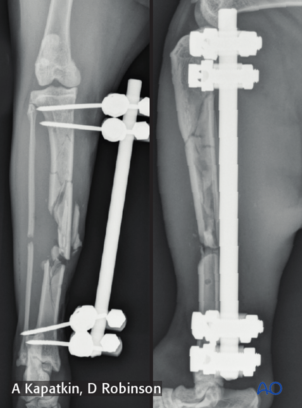 complications with tibial shaft fractures