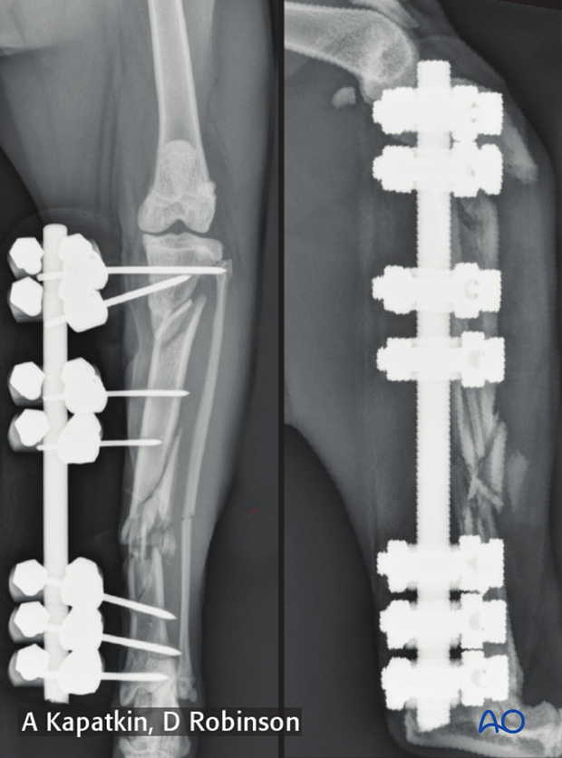 complications with tibial shaft fractures