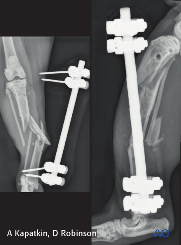 complications with tibial shaft fractures