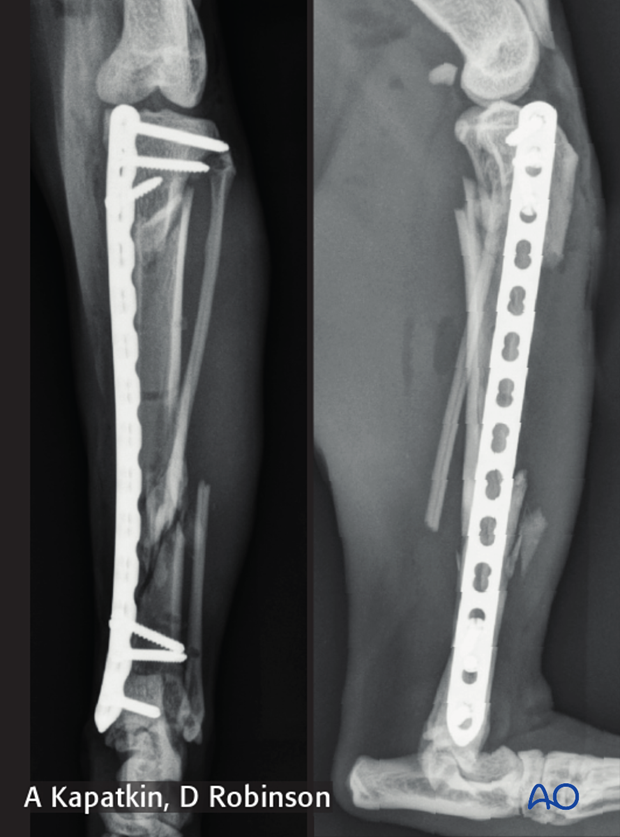 complications with tibial shaft fractures