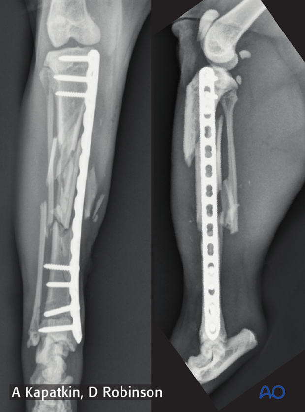 complications with tibial shaft fractures