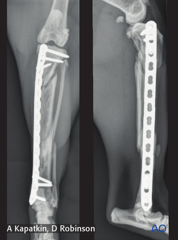 complications with tibial shaft fractures