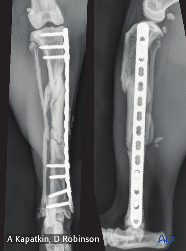 complications with tibial shaft fractures