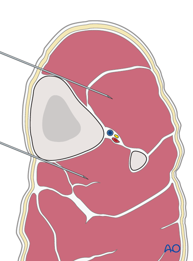 external fixator