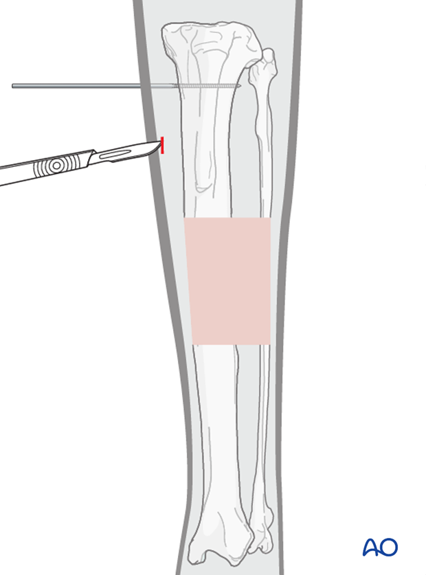 external fixator