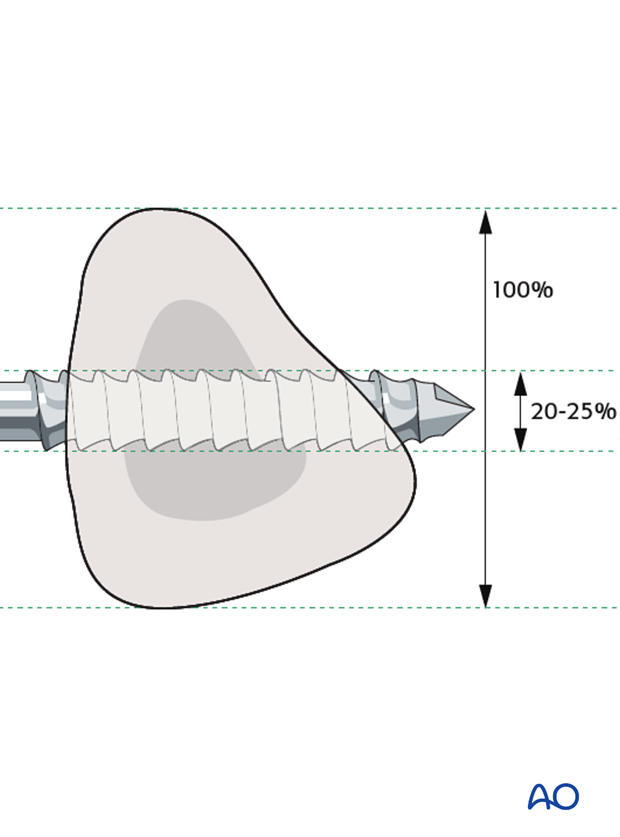 external fixator