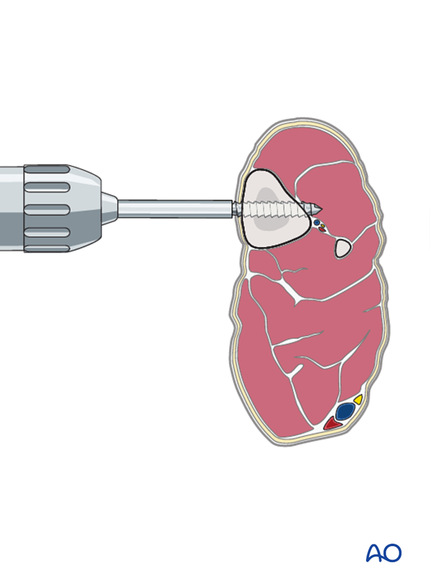 external fixator