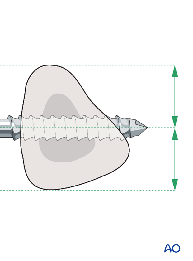 external fixator