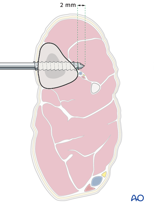 external fixator