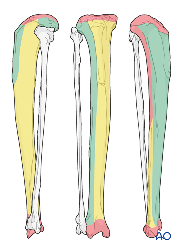 external fixator