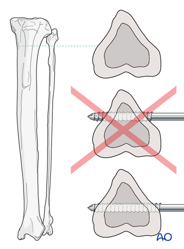 external fixator