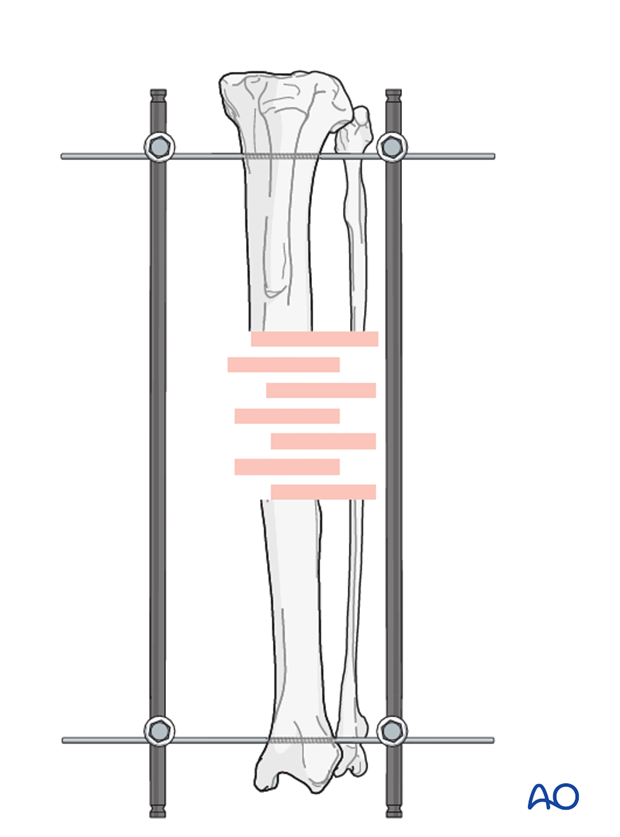 external fixator