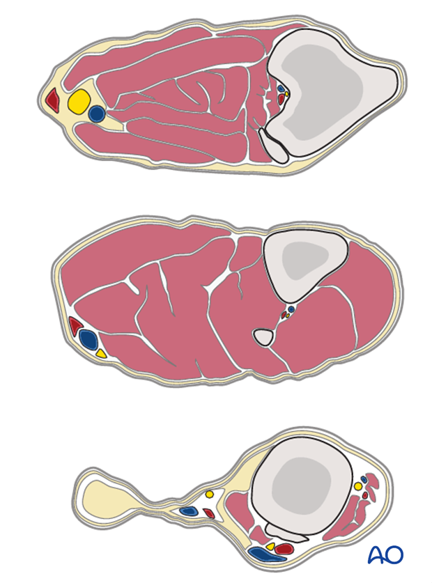 complications with tibial shaft fractures