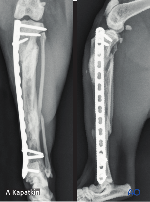 complications with tibial shaft fractures