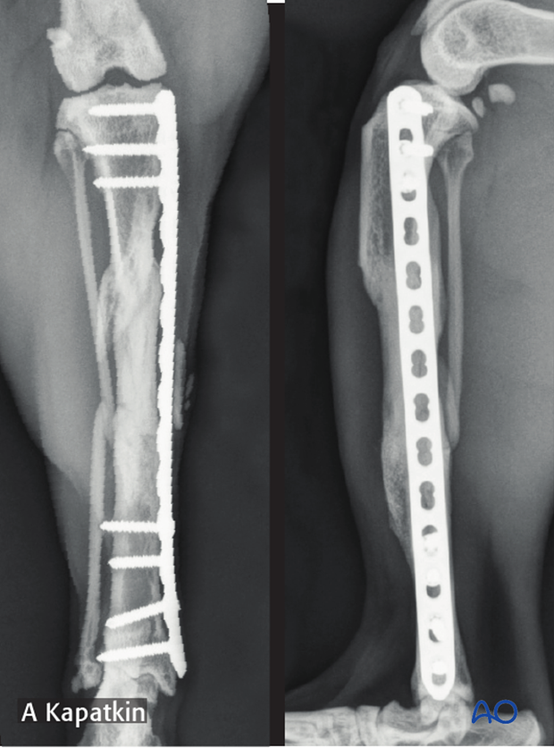 complications with tibial shaft fractures