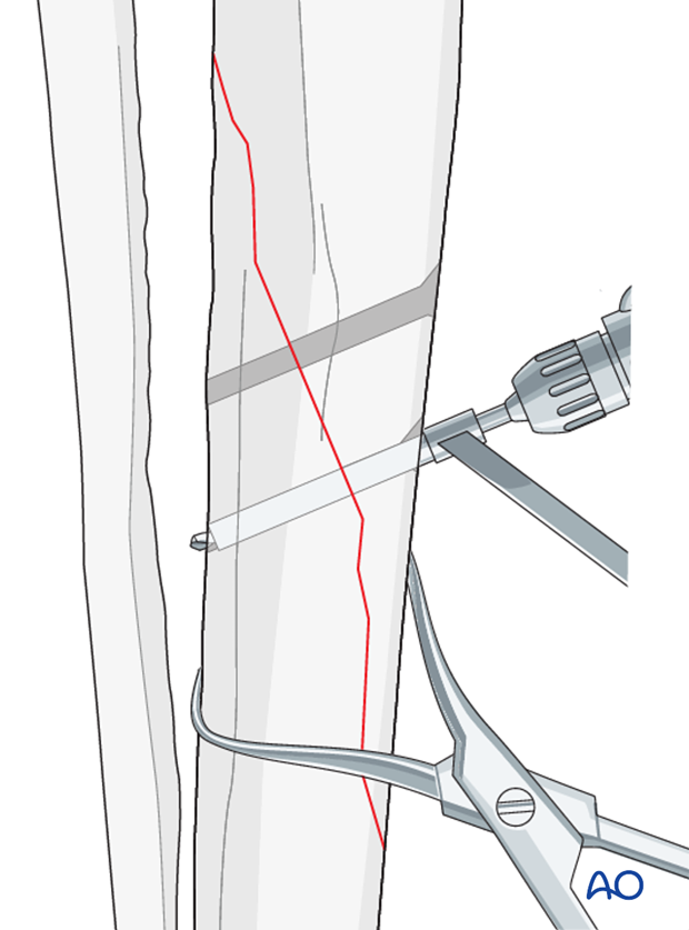 lag screw fixation