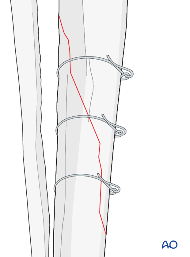 cerclage wires technique