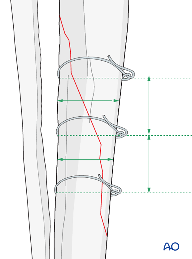 im pin and cerclage wires