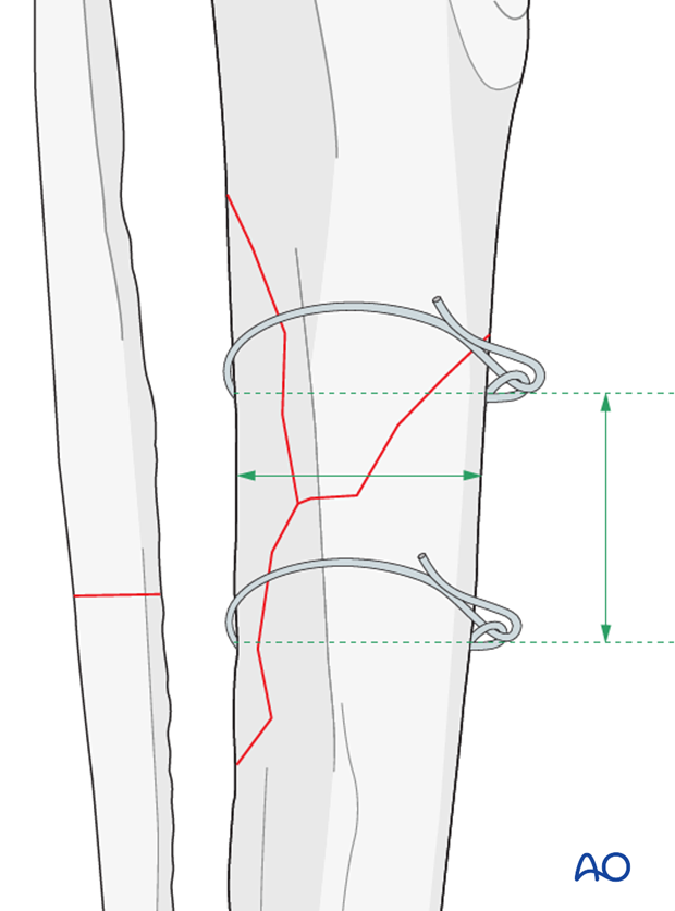 cerclage wires technique