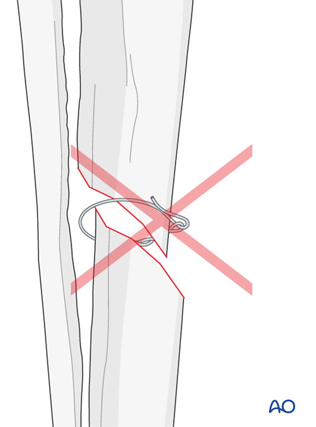 cerclage wires technique