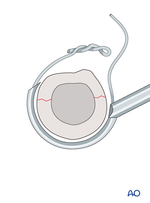 cerclage wires technique