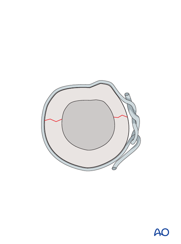 cerclage wires technique