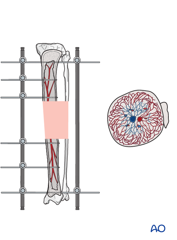 general considerations on external skeletal fixators