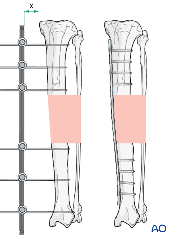 general considerations on external skeletal fixators