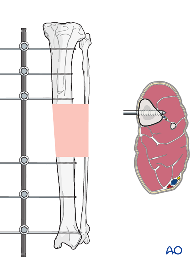 general considerations on external skeletal fixators