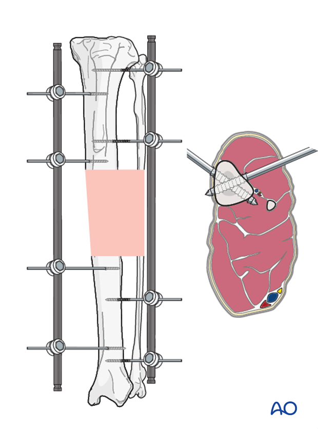 general considerations on external skeletal fixators