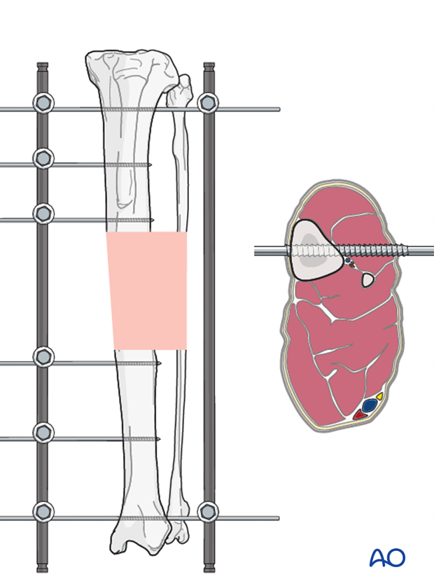 general considerations on external skeletal fixators