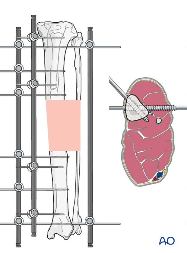 general considerations on external skeletal fixators