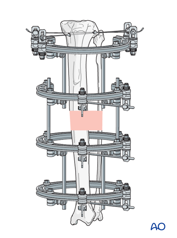 general considerations on external skeletal fixators