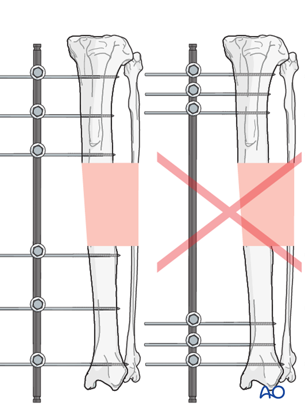 general considerations on external skeletal fixators