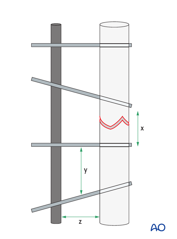 general considerations on external skeletal fixators