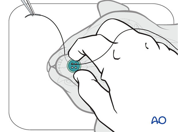 Nonsurgical fracture management for Midface - Frontonasal fracture