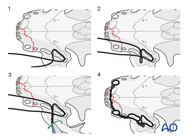 Rostral intraoral splint fixation for Midface - Panfacial fracture