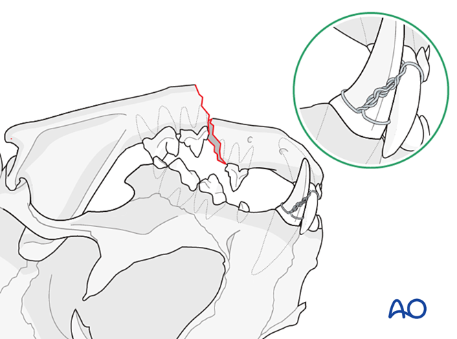 Plate fixation for Mandible - Body fracture